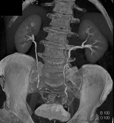 Normal CT Urogram - CTisus CT Scan