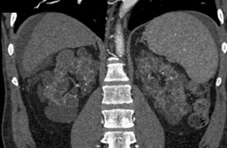 Cystic Uremic Disease - CTisus CT Scan