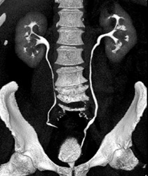 Normal CT Urogram - CTisus CT Scan