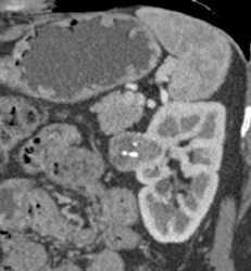 Renal Cell Carcinoma - CTisus CT Scan