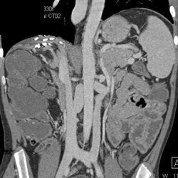 Duplicated Inferior Vena Cava (IVC) - CTisus CT Scan