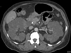 Polycystic Kidneys With Left Renal Stones - CTisus CT Scan