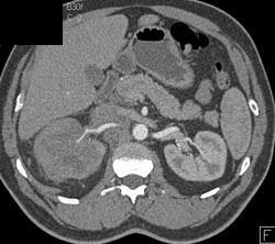 Transitional Cell Carcinoma - CTisus CT Scan