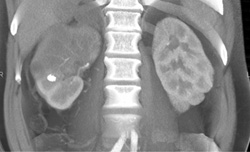 Transitional Cell Carcinoma - CTisus CT Scan