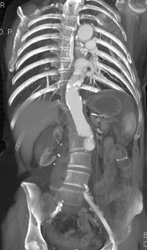 Renal Laceration - CTisus CT Scan