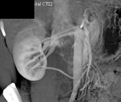 3 Right Renal Arteries - CTisus CT Scan