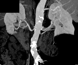 Renal Artery Stenosis - CTisus CT Scan