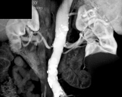 Renal Artery Stenosis - CTisus CT Scan