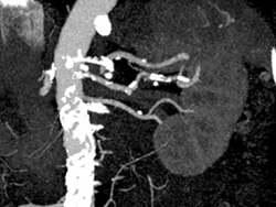 Calcified Plaque in Renal Arteries - CTisus CT Scan