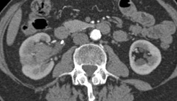 Transitional Cell Carcinoma - CTisus CT Scan