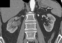 Transitional Cell Carcinoma - CTisus CT Scan