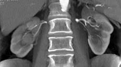 Transitional Cell Carcinoma - CTisus CT Scan