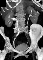 Dilated Right Ureter and Pelvis (stent in Ureter) - CTisus CT Scan