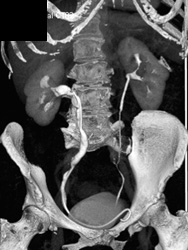 Stent in Right Ureter - CTisus CT Scan