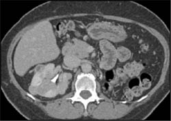 Renal Cell Carcinoma (vascular) - CTisus CT Scan