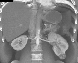 Renal Cell Carcinoma - CTisus CT Scan