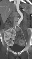 Pelvic Kidney - CTisus CT Scan