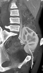 Pelvic Kidney - CTisus CT Scan