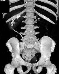 Malrotated Kidney - CTisus CT Scan