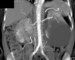 Tuberculosis (TB) of Ureter - CTisus CT Scan