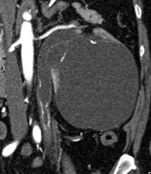Calcified Proximal Ureter Secondary to Tuberculosis (TB) - CTisus CT Scan