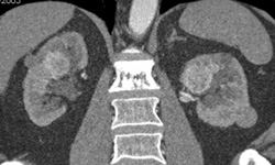 Multiple Renal Cell Carcinomas With Bone Metastases - CTisus CT Scan