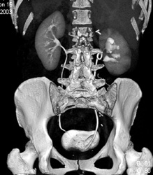 Scarring of Left Kidney - CTisus CT Scan