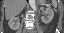 Mild Hydronephrosis - Kidney Case Studies - CTisus CT Scanning