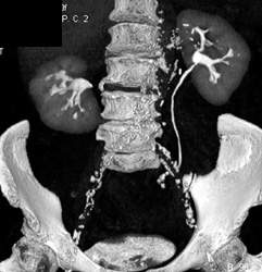 Ct Urogram - CTisus CT Scan