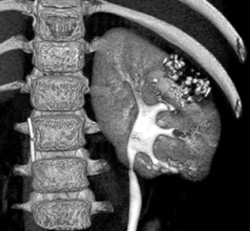 Scarring of Kidney - CTisus CT Scan