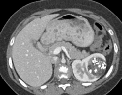 Previously Treated Wilms Tumor - CTisus CT Scan