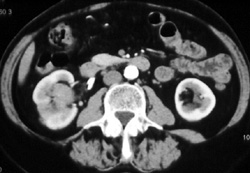 Transitional Cell Carcinoma - CTisus CT Scan