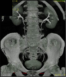 Normal CT Urogram - CTisus CT Scan