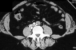 Lymphangiogram - CTisus CT Scan