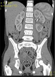 Renal Laceration - CTisus CT Scan