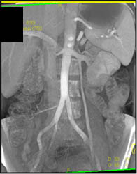 Normal Gonadal Vein - CTisus CT Scan