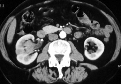 Transitional Cell Carcinoma - CTisus CT Scan