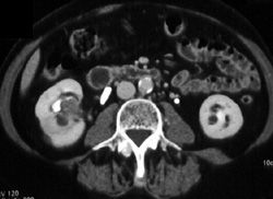 Transitional Cell Carcinoma - CTisus CT Scan