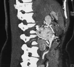 Renal Cell Carcinoma Metastatic to the Pancreas - CTisus CT Scan