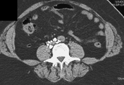 Fistulae From Lymphangiogram to Kidney - CTisus CT Scan