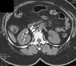 Fistulae From Lymphatics to Kidney - CTisus CT Scan