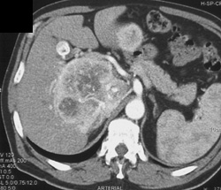 Liver Metastases From Renal Cell Carcinoma - CTisus CT Scan