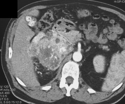 Metastatic Renal Cell - CTisus CT Scan