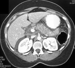 Fluid in Pararenal Space Due to Pancreatitis - CTisus CT Scan