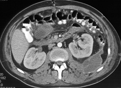 Fluid in Left Posterior Pararenal Space - Kidney Case Studies - CTisus