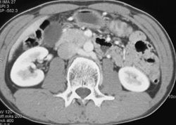 Retroaortic Renal Vein - CTisus CT Scan