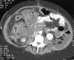 Abscess in Left Posterior Pararenal Space - CTisus CT Scan