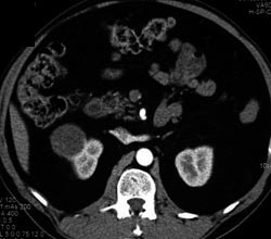 Cystic Renal Cell Carcinoma - CTisus CT Scan