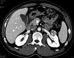 Renal Cell Carcinoma - CTisus CT Scan