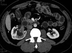 Transitional Cell Carcinoma - CTisus CT Scan